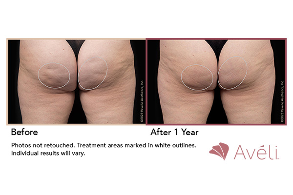 aveli-cellulite-treatment-subpage-ba-4